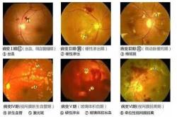 流产后眼睛模糊怎么办