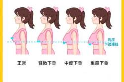产后胸部下垂如何恢复