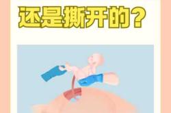 哪里能看二胎剖腹产手术视频