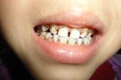 婴儿牙齿发黄是怎么回事