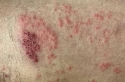 产后湿疹图片长啥样