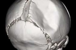 新生儿头盖骨有什么特点