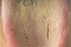 婴儿舌根黄是怎么回事