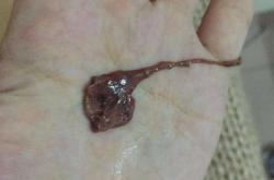 药物流产后感染症状有哪些
