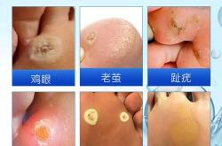 备孕能用鸡眼膏吗