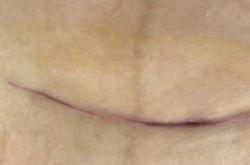 剖腹产吃什么伤口愈合快