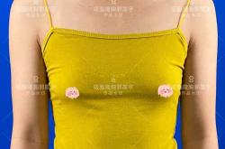 产后胸部下垂干瘪怎么办