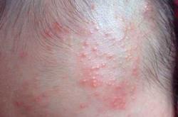 新生儿额头中间红印啥情况