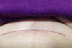 剖腹产出现滑线怎么办