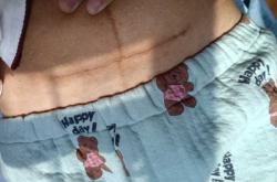 剖腹产刀疤为何刺痛