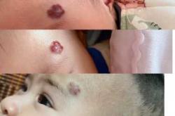 新生儿血管瘤是由什么原因引起