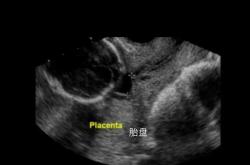 剖腹产胎盘厚是怎么回事