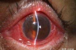 产后青光眼有哪些症状表现