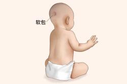 新生儿头上长包怎么办