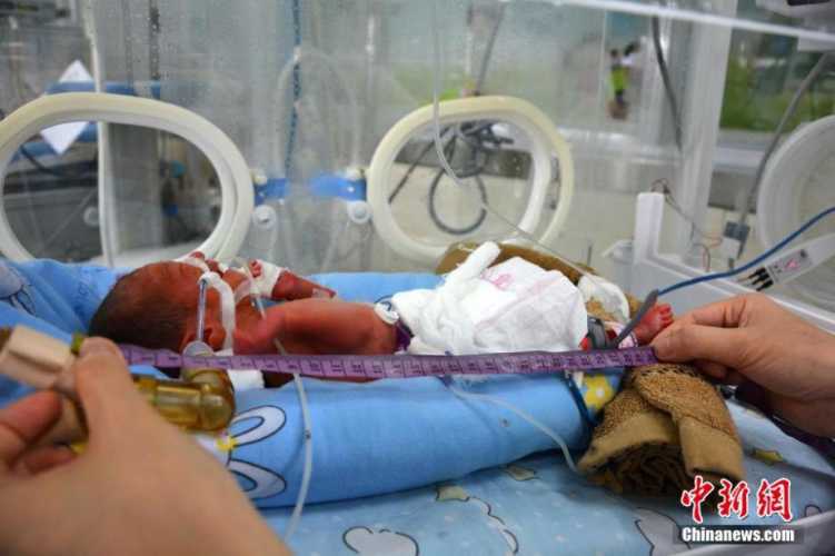 新生婴儿贫血怎么回事-第1张图片