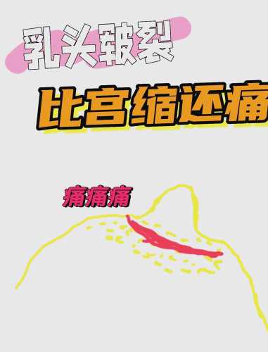 产后乳头不通怎么办-第1张图片