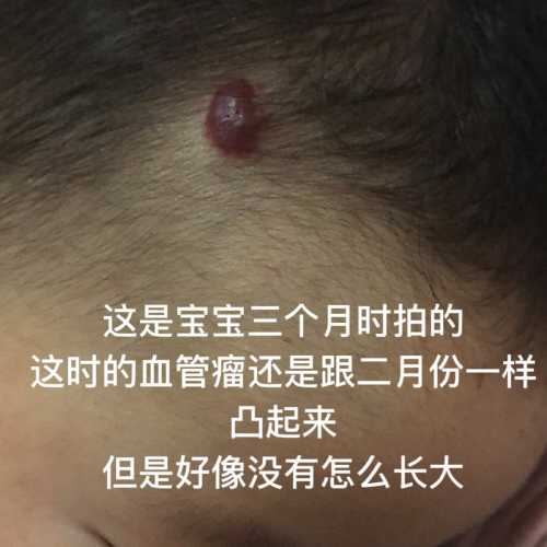 婴儿头部血管瘤该怎么处理-第1张图片