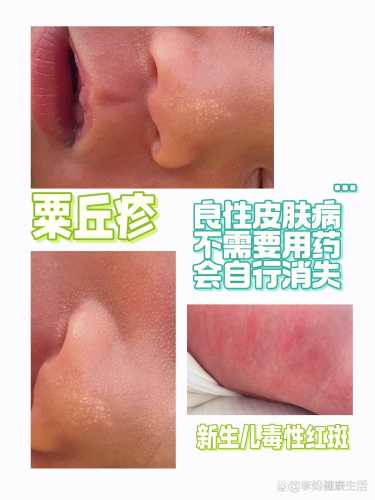 新生儿眼皮红斑图是怎么回事-第1张图片
