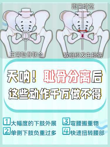 产后耻骨修复方法有哪些-第1张图片