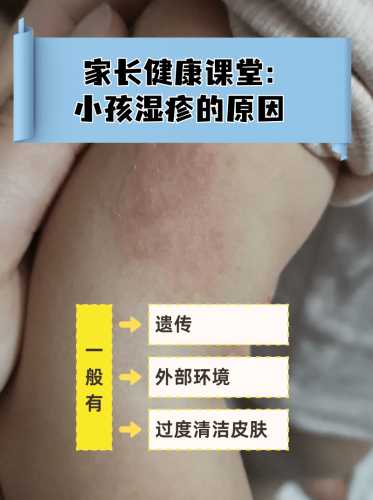 月子里宝宝长湿疹怎么办-第1张图片