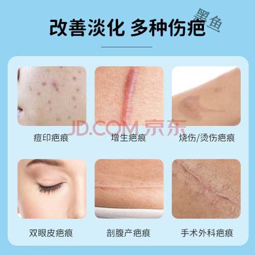 剖腹产伤口护理凝胶怎么选-第1张图片