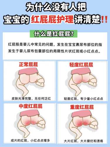 新生儿屁屁红怎么办-第1张图片