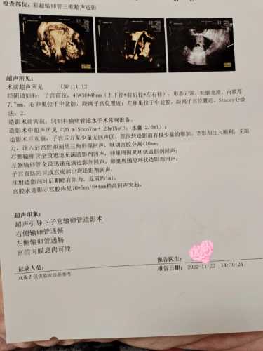 男性有息肉对备孕有影响吗-第1张图片