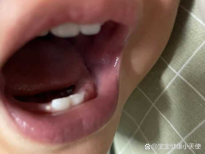 婴儿牙龈发白咋回事-第1张图片
