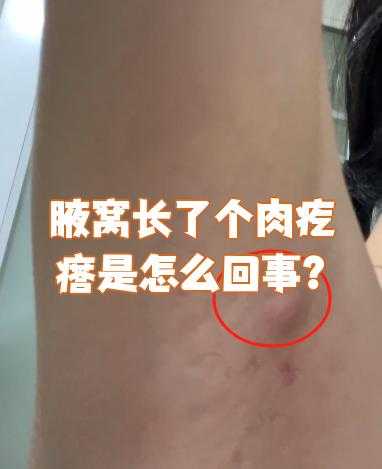 生产后腋窝下有肉疙瘩怎么办-第1张图片