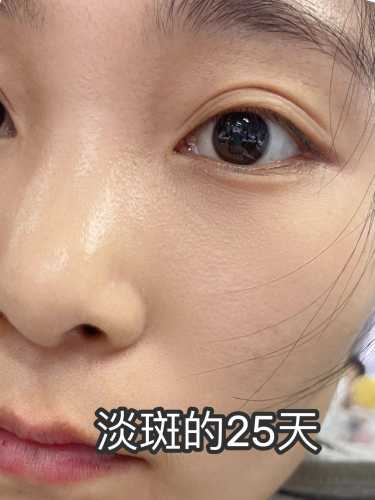 引产后脸长斑如何消-第1张图片