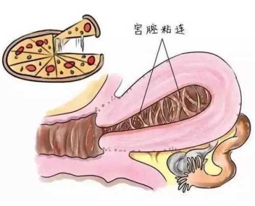 婴儿阴道粘连怎么办-第1张图片