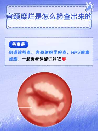 宫颈柱状上皮异位是正常生理现象，并非疾病，通常无需用药。若产后有相关不适，建议及时就医检查，由专业医生判断是否存在其他宫颈问题并给予针对性建议，切勿自行用药。-第1张图片
