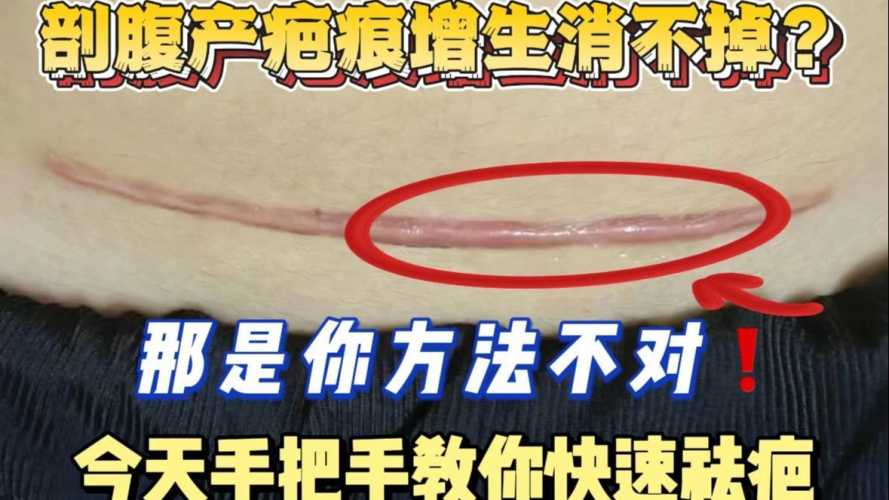 剖腹产疤痕是否都会增生-第1张图片