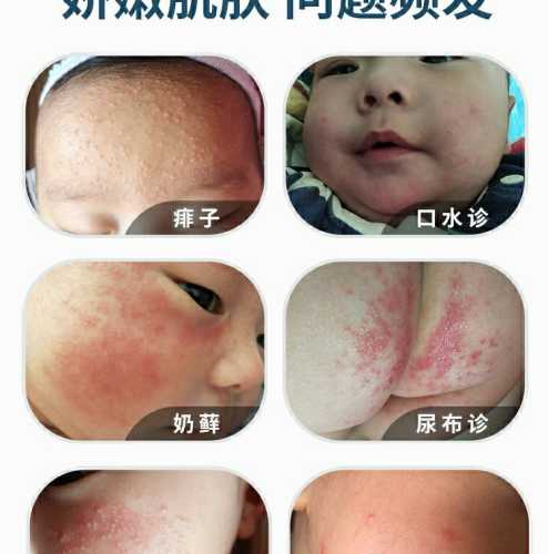 婴儿的湿疹是什么样子的-第1张图片