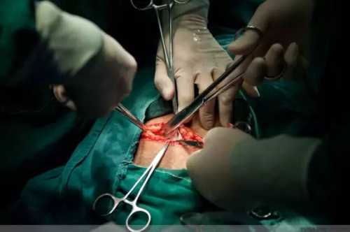 剖腹产吃黑鱼刀口真不痒吗-第1张图片