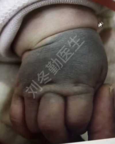 新生儿长痣是怎么回事-第1张图片