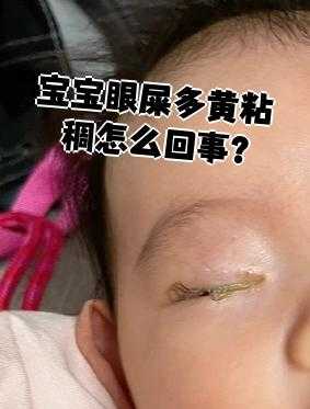 婴儿多眼屎是什么原因-第1张图片