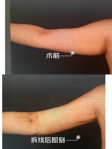 婴儿胳膊粗是正常现象吗-第1张图片