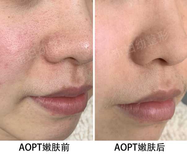 怀孕能打光子吗-第1张图片