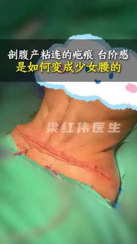 剖腹产后肚子下垂怎么办-第1张图片