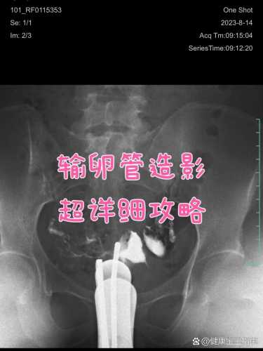 四联法吃完多久能备孕-第1张图片