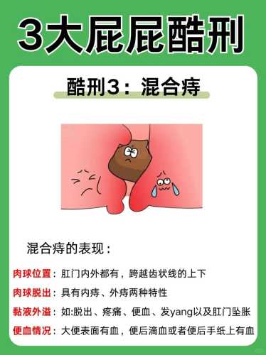 产后会得痔疮吗-第1张图片