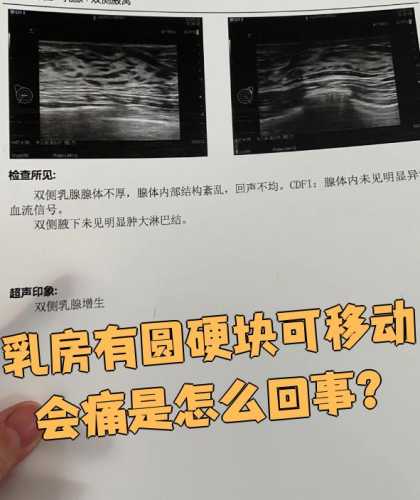 乳腺增生能怀孕吗-第1张图片