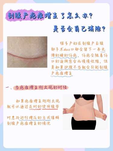 剖腹产刀口崩裂怎么办-第1张图片