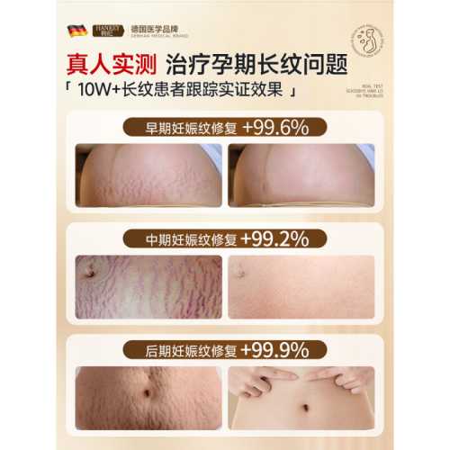 产后妊辰纹能去除吗-第1张图片