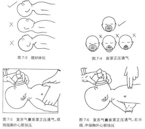 新生儿输注该注意什么-第1张图片