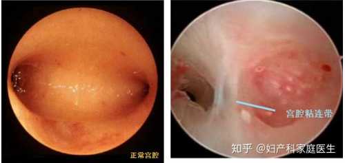 剖腹产后内膜多少厚度算正常-第1张图片