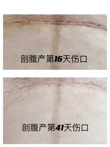 剖腹产伤口多久会开始变红-第1张图片