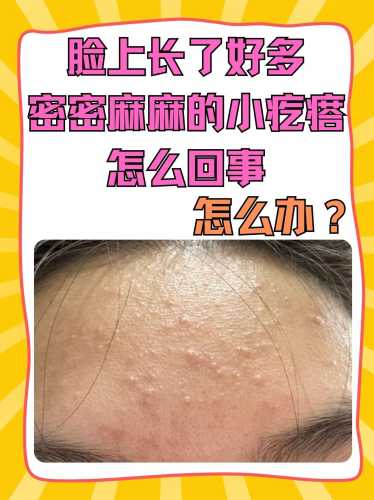 新生儿脸上长小疙瘩怎么办-第1张图片