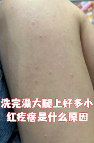 产后皮炎的原因是什么-第1张图片